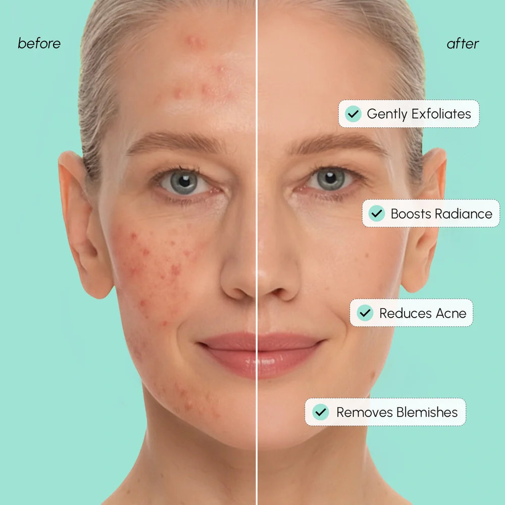 Azelaic Acid Glow Pads – Soothe Redness, Reduce Blemishes & Even Skin Tone