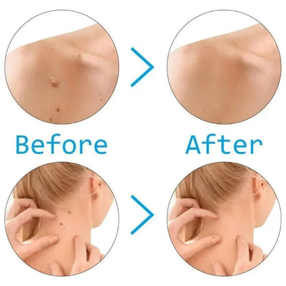 Skin Tag Remover Kit | Skin Care Rubber Bands for Face Mole and Wart Removal