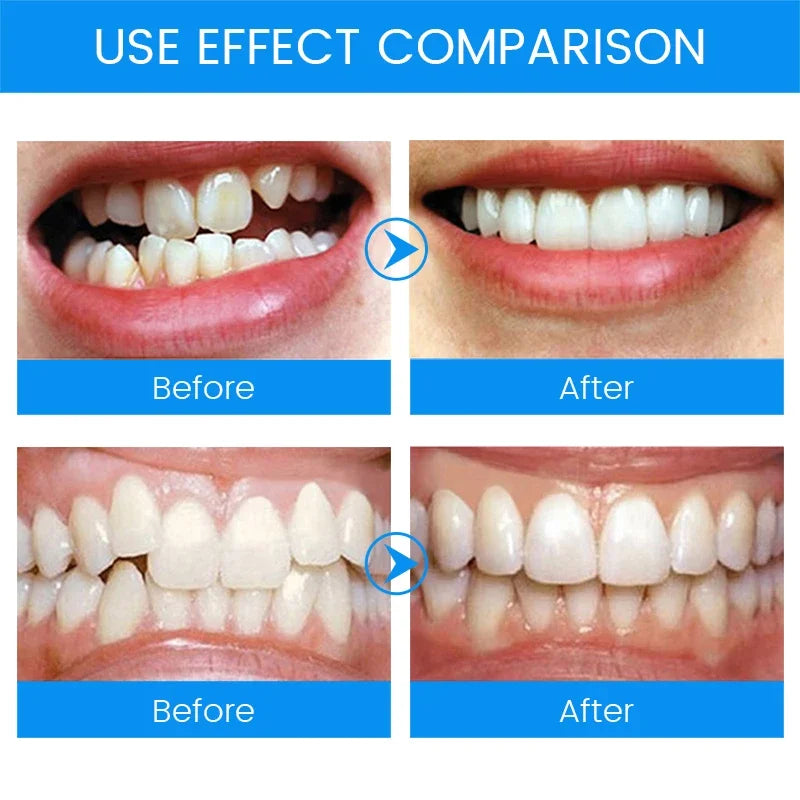 Anti Snoring Mouth Guard 3 Stages | Bruxism Teeth Grinding Sleep Aid
