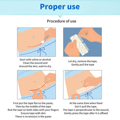 5 Strips Wound Skin Closure Strips | Medical Suture Free Surgical Tape